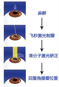 超极致Ziemer飞秒激光